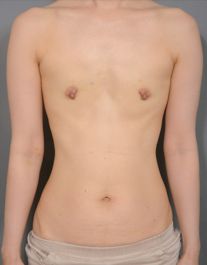 3 Month Update Prophylactic bilateral mastectomy with an aesthetic flat  closure 